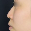 하이코코 | 코 실리프팅 후기, 하이코를 활용한 코끝 높이기?