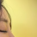 술이마시따 | [후기] 이마필러 맞은 이후 3일째되는 날 | 이마필러 붓기 | 콧대부기