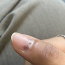 상암정형외과의원 | 손톱에 구멍내는 고통을 나도 알고싶지 않았어 (차문에 손 끼임)