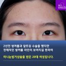 비씨아이성형외과의원 | 제대로 된 쌍커풀재수술후기 확인하고 싶어!