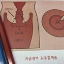큐어람한의원 | 원추절제술 후기 재수술 질문이 많다는 것을 아시나요?
