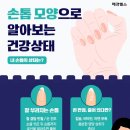 손톱모양