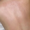 강희약국 | 안산 고잔동 등드름관리 드위에스테틱 등필링 강력추천 후기