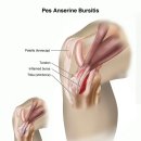 Pes Anserine (Knee) Bursitis 이미지