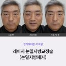 뮬피부과의원 | 부산눈밑지방재배치 재수술후기? 뮬피부과 케이스 확인하세요.