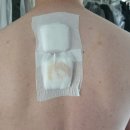 큐병원 | 부산 큐병원 외과 피지낭종 제거수술 후기