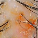 선일초등학교 | 신사동탈모병원에서 남성탈모 진단받고 치료 받은 후기 (탈모약처방)