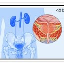 전립선염 증상 - 전립선염 원인과 자연치유 및 치료 이미지