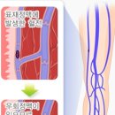 혈전증의 사망률이 암(癌)보다 높다! 이미지