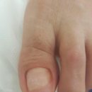 레푸스네일 이미지