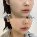 강남 선릉피부과 쿨소닉 리프팅 5000샷 후기 맑은선의원 추천