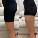 멍시원 | 신사 다이어트 병원 허벅지 지방분해주사종류와 멍 2회차 후기