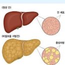 지방간 원인 증상 치료 (알콜성, 비알콜성) 이미지