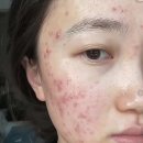 이마 좁쌀여드름 원인 장녹수미안법 사용 후기