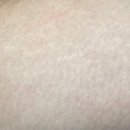 일루젼 | [안양 튼살케어] 일루젼스칼프 안양점 후기 - 튼살이 고민된다면 튼살 솔루션 관리