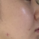 [메디테라피] 토타롤 스프레이 세럼 ! 여드름 트러블 방어막 솔직 후기