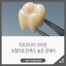 상도동치과, 지르코니아 크라운 보철치료 만족도 높은 곳에서