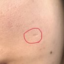 아침빛한의원 | 수원후한의원 트랜스테라피 2회차 내돈내산 후기 ㅣ여드름 패인흉터