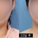 [네이버카페 사진후기 By 안개비소녀님] 턱지방흡입 수술 4주차.. 병원 사진 투척이요^^ 이미지