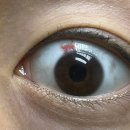 평안안경 | 대구 누네안과 병원 EVO+ICL 안내 렌즈삽입술 당일 후기