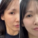 강남-100 | 강남 신사역 피부과 울트라콜100 풀페이스 1차 후기