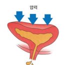 재채기하다 흘러나오는 민망한 소변 복압성 요실금 증상 케겔운동 효과 있을까? 이미지