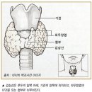 의사가 말하는 급증하는 갑상선암 바로알기 이미지