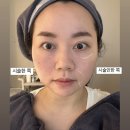 신사역피부과 통증 없는 리프팅 ‘올타이트’ 후기