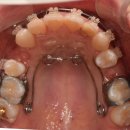 HELIX 병원앞 | [유림치과교정/직원교정 중 후기] 안보면 후회할걸요? 꼭 보세요 클릭!