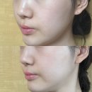 콜라당 | 홍대입구역피부과 | 효과 좋은 콜라스터 오리지널 스킨부스터후기