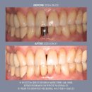 클린이치과의원 | 30대 임플란트 후기? 발치 후 임플란트, 타이밍 놓치면 안 되는 이유