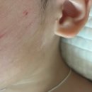 자연한의원 | 선정릉 자연재생한의원 화상 찰과상 흉터 치료 후기