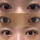 31140-9-21-7 | 직장인 쌍수 한쪽눈 눈매교정 매몰 재수술+뒷밑트임 후기 ! 수술당일 ~ 9일차까지 회복과정👀