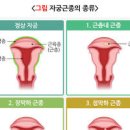 자궁근종 원인 증상 치료 자궁근종 제거 하혈 용종 자궁근종 예방법 이미지