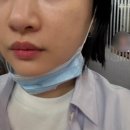 압구정 피부과 팔자주름 쥬베룩볼륨 셀인아웃 윤곽주사 후기