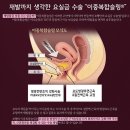 유정의원 | 기침 요실금 수술 후기, 그 시작은 사소했다