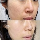 청담피부과 모공레이저 버츄RF 받고온 후기! 통증, 금액 공유