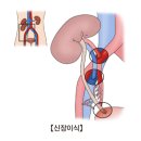 말기 신질환(End stage renal disease) 신장 비뇨기질환이란? 이미지