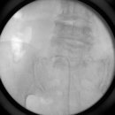 척추신경성형술[Percutaneous epidural neuroplasty] 이미지