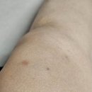 통증의학과 가서 주사맞고 진상 아줌마 된 후기(2탄)