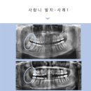 안아픈치과의원 | 옥정치과추천 안아픈 사랑니 발치 후기, 연세가온치과 -62