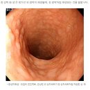 청보한의원 | 위축성 위염 / 장상피화생 치료 후기