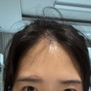 라베성형외과의원 | 인천 송도 피부과 : 흉터레이저, BBL레이저, MOXI레이저, 피코레이저후기(솔직후기)