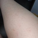 미주병원 | 채혈 후 미주신경성실신한 후기 ~눈 뜨니 쓰러져있던 나~