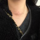 내사랑똥강아지 | 좋은문화병원 갑상선암 수술 후기