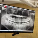 첨단윤치과의원 | [상동역 치과] 🦷 힐링윤치과_사랑니 발치 후기 / 매복 사랑니 / 사랑니 발치 전문 / 부천 치과 / 부천...