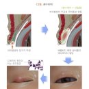 질병수술비(특정 2대질병 제외)보장 특별약관(보험금의 지급사유) 이미지