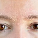얼굴 전신 피부건조증으로 따가움 증상 원인 해결 방법 이미지