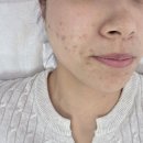 365행복케어 | 광주여드름관리 [365메디스킨 광주본점] 압출부터 플라즈마까지 풀코스 받은 후기