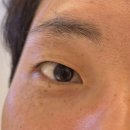 천안 스마일 라식 내 돈 내산 후기 결과&amp;할인&amp;가격 공유